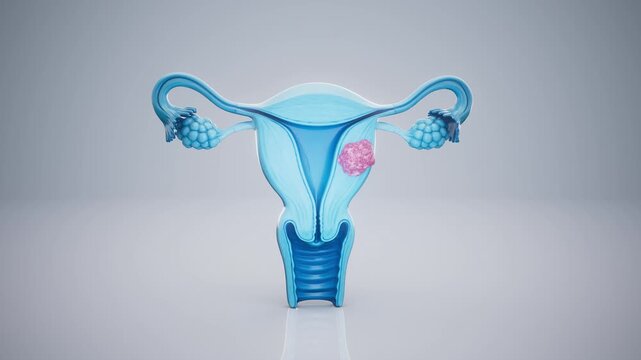 Conceptual 3D animation of a uterine fibroid and uterine anatomy