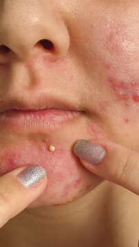 a woman squeezing a pus filled pimple on her chin, illustrating acne, facial inflammation and problematic skin.