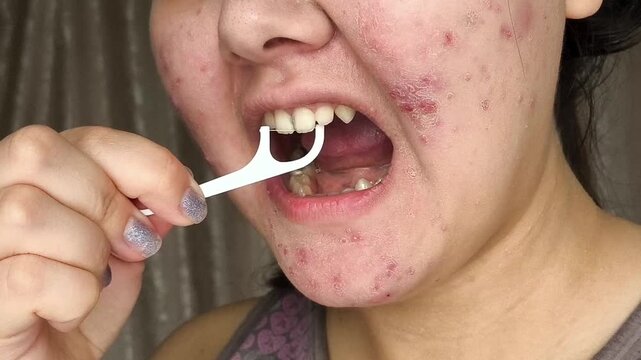 Woman cleaning between her teeth with a dental flosser, illustrating interdental hygiene and prevention of tooth decay.