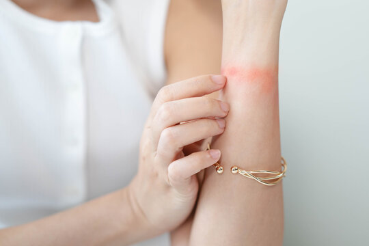 Close-up of a woman scratching a red itchy skin rash on her wrist caused by an allergic reaction to a metal bracelet