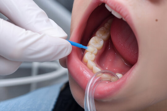 Dental fluoride varnish application on teen molars during oral procedure. Professional assists with fluoride treatment using applicator on young patient's teeth.