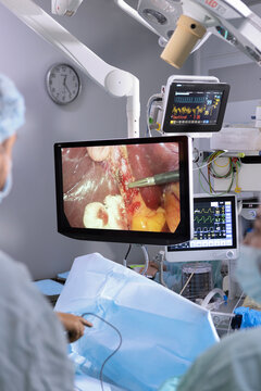 Surgeon watching monitor during laparoscopic surgery. Endoscopic view of internal organs on screen. Operating room equipment. Clinical procedure. Vital signs monitor