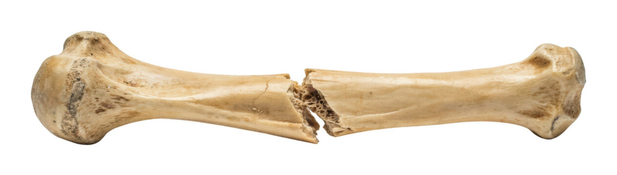 broken bone png fractured bone png cracked bone isolated transparent background image