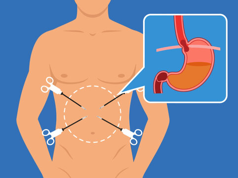 Medical Vector Illustration of Laparoscopic Gastric Surgery for Hiatal Hernia and Acid Reflux Treatment
