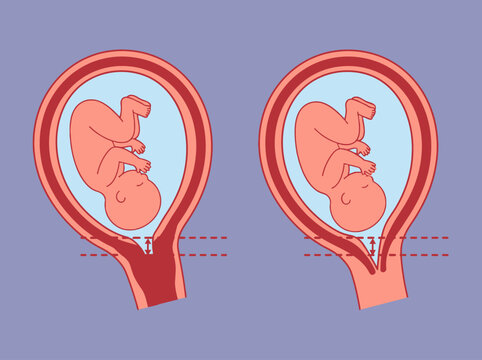 Medical diagram of cervical effacement and shortening during pregnancy, comparing a normal cervix to a shortened cervix for labor or preterm birth education.
