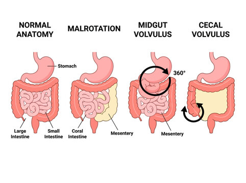 Medical Diagram Comparing Normal Anatomy, Intestinal Malrotation, Midgut Volvulus, and Cecal Volvulus