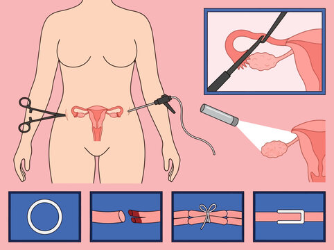Medical Illustration of Tubal Ligation and Laparoscopic Sterilization Methods for Female Reproductive Health
