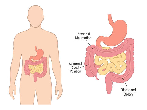 Medical Illustration of Intestinal Malrotation Showing Abnormal Cecal Position and Displaced Colon in Human Digestive System