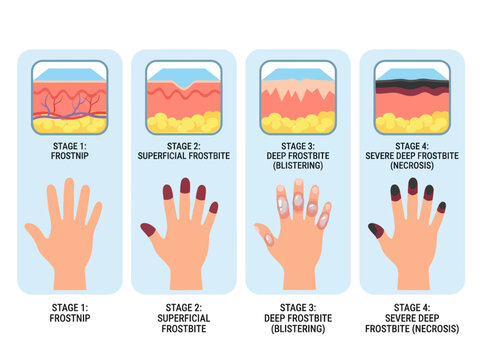 Stages of Frostbite Infographic - Medical Diagram Showing Frostnip, Superficial Frostbite, Deep Blistering, and Severe Necrosis Skin Damage on Hand