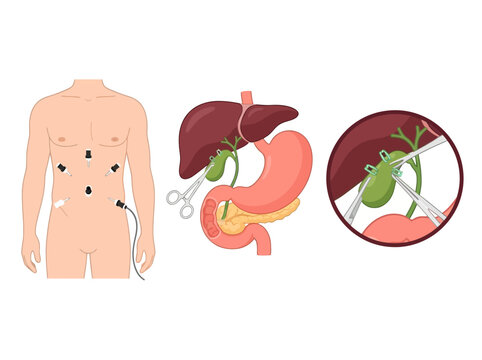 Laparoscopic Cholecystectomy Surgical Procedure Diagram: Gallbladder Removal with Trocar Placement and Internal Anatomy Illustration
