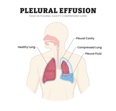 Pleural Effusion Lung labeled diagram, educational respiratory poster design, fluid accumulation and lung compression. Labeled healthy lung, pleural cavity, compressed lung, pleural fluid illustration