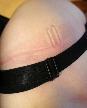 Close-up of a skin with a black bra strap. Pressure marks and hardware imprint are visible. Topic: Proper size and care for sensitive skin.