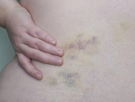 There is a massive bruise on the side of the torso, and the arm is lying on top.