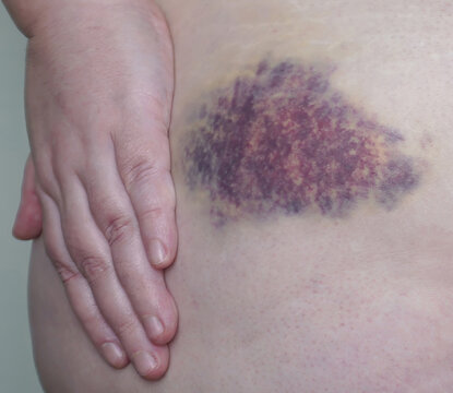 A close-up of a hematoma on the skin of the abdomen, the arm covers the bruise area.