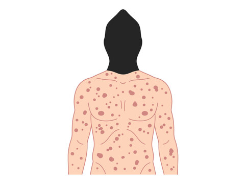 Illustration of a Male Torso with Mpox or Smallpox Rash and Lesions, Medical Concept of Infectious Skin Disease