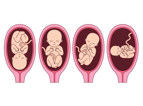 Medical Illustration of Different Baby Fetal Positions in the Womb Including Cephalic Breech and Transverse Presentation