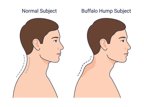 Buffalo Hump vs Normal Posture Medical Illustration Showing Dorsocervical Fat Pad Comparison