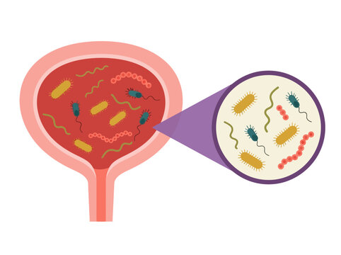 Urinary Tract Infection Illustration Showing Bacteria in the Human Bladder