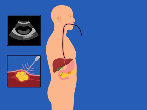 Medical Illustration of Endoscopic Ultrasound (EUS) Procedure with Fine Needle Aspiration (FNA) Biopsy for Pancreatic Cancer Diagnosis