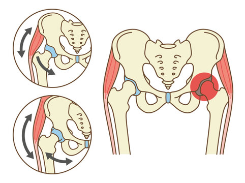 Human Pelvis and Hip Anatomy Diagram Illustrating Joint Pain and Biomechanical Movement
