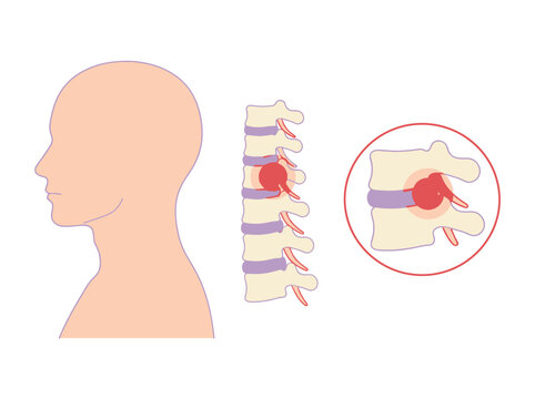 Cervical Herniated Disc Illustration - Human Neck Anatomy and Spinal Nerve Compression Diagram