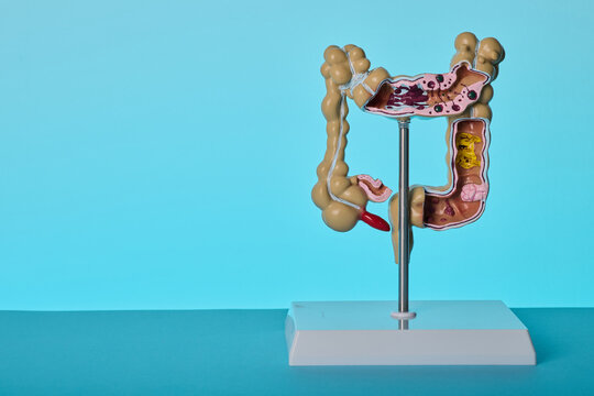 Intestinal colon pathology model. Medical diagnostics of ulcerative colitis, polyps, and colorectal cancer.