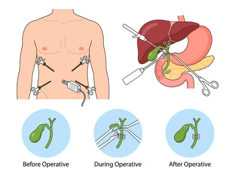Laparoscopic Cholecystectomy Procedure Illustration Showing Gallbladder Removal Surgery Steps, Internal Organs, and Surgical Instruments