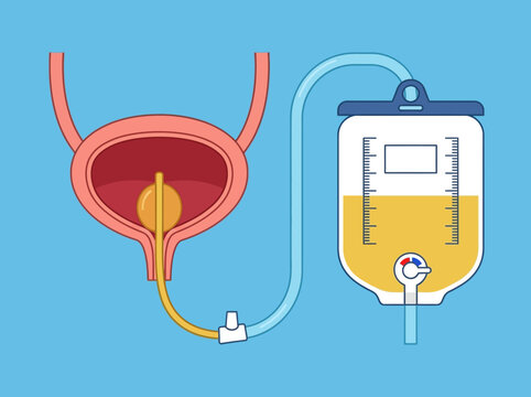 Medical Illustration of a Human Bladder with a Urinary Foley Catheter and Drainage Bag