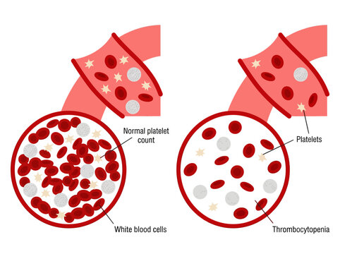 Medical Illustration Comparing Normal Platelet Count and Thrombocytopenia with Red and White Blood Cells