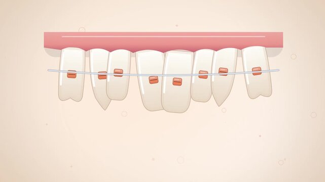 Orange brackets and archwire straightening teeth on cream background
