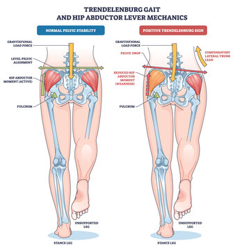 Trendelenburg gait hip abductor lever compares normal stability vs positive sign, featuring pelvis, gluteus medius, and force vectors on stance and unsupported legs. Outline diagram