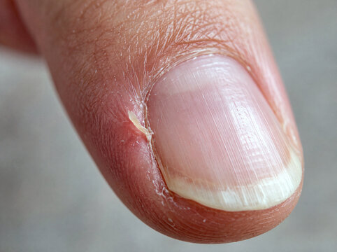 Hangnail and dry peeling skin beside a fingernail