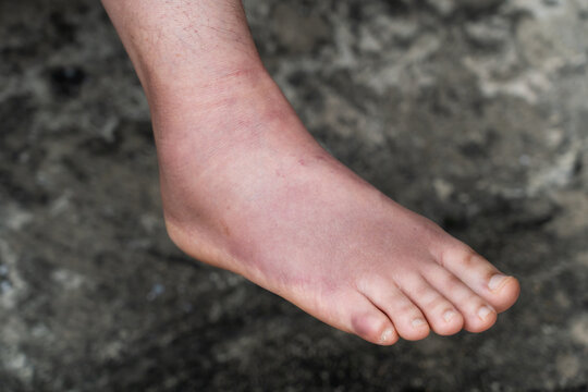Swollen Foot After Cast Removal of Metatarsal Fracture