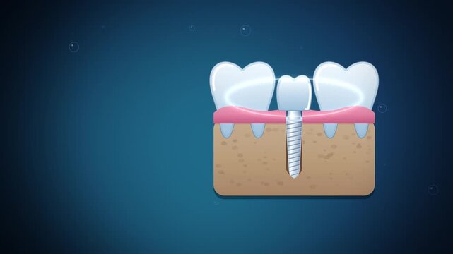 Dental implant crown and screw in jawbone on dark blue seamless loop