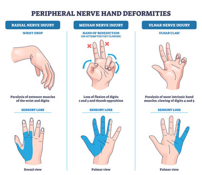 Peripheral nerve hand deformities diagram showing radial, median, and ulnar injuries with hands, nerve labels, and blue sensory loss shading for quick comparison, transparent background.