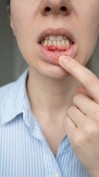 Woman pointing at her lower teeth showing red inflamed gums indicating periodontal disease or gingivitis