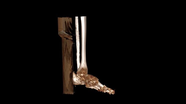 3D Virtual Reality Surface Rendering CT Scan of Left Ankle and Foot Skeleton