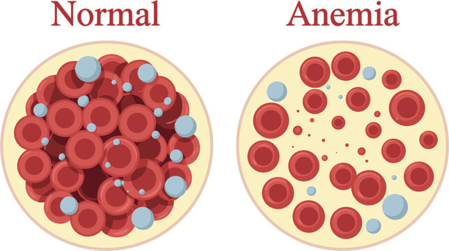 Anemia Comparison Diagram Vector Illustration Showing Normal Blood Flow vs Low Red Blood Cell Count for Hematology and Medical Science Education Graphic Designs