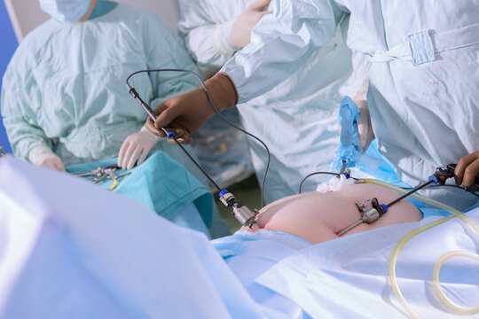 Laparoscopic abdominal surgery. Surgeon hand in brown glove holds laparoscopic instrument during abdominal surgery. Trocars inserted into patient skin