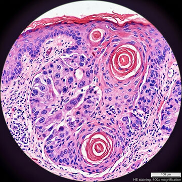 Microscopic View of Skin Cancer Cells 400x Magnification Histology of Malignant Melanoma