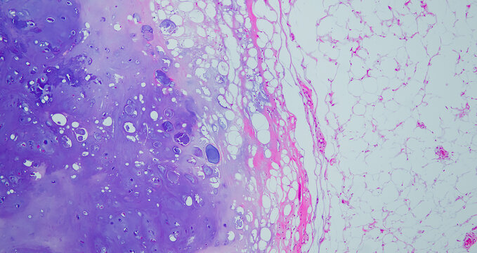 Chondroid lipoma histology showing chondromyxoid matrix with vacuolated cells adjacent to mature fat, H&E stain