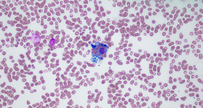 Hemophagocytosis on peripheral smear with macrophage engulfing blood cells, Wright-Giemsa stain, 40x