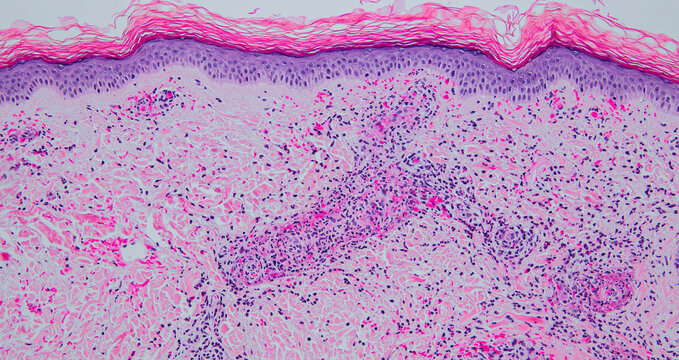 Leukocytoclastic vasculitis with perivascular neutrophils, nuclear dust, and extravasated red cells, H&E stain