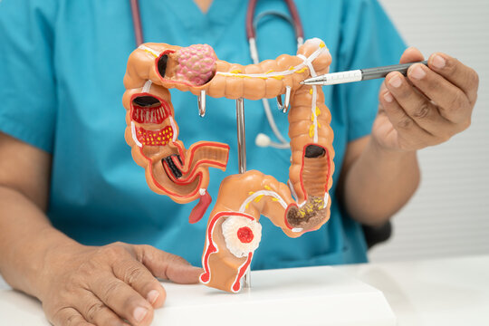 Colorectal cancer, doctor holding intestine colon human anatomy model.