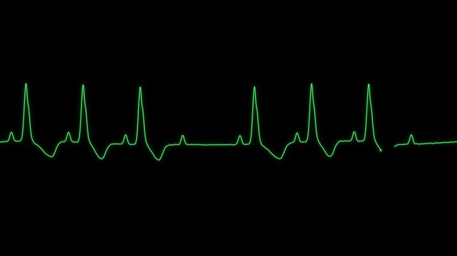 Mobitz type II second degree heart block ECG on a monitor loop