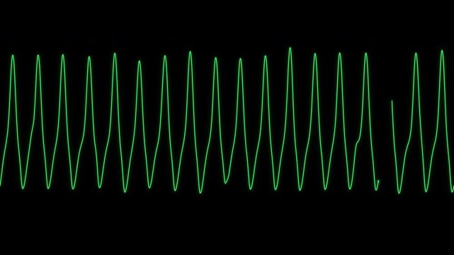 Ventricular tachycardia ECG wide complex rhythm on a patient monitor