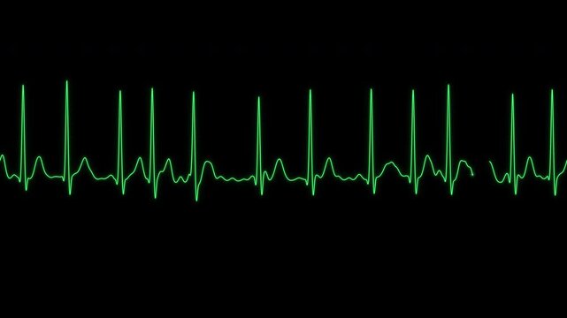 Atrial fibrillation with rapid ventricular response ECG monitor loop