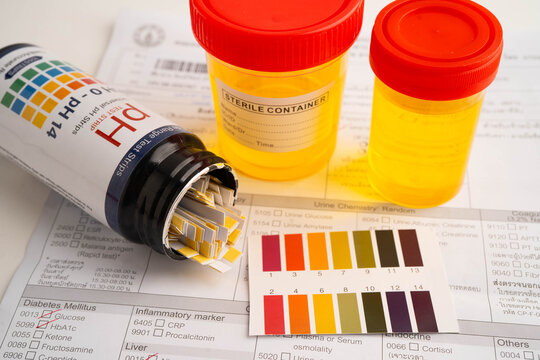 Urinalysis, urine cup with reagent strip pH paper test and comparison chart in laboratory.