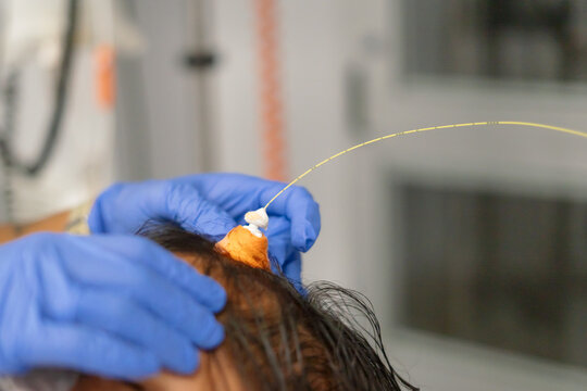 Doctor performing brain surgery placing electrodes on patient