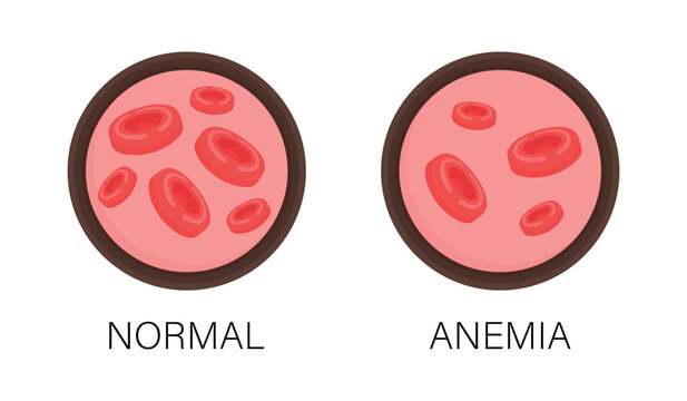 Normal and low platelet count in blood with anemia